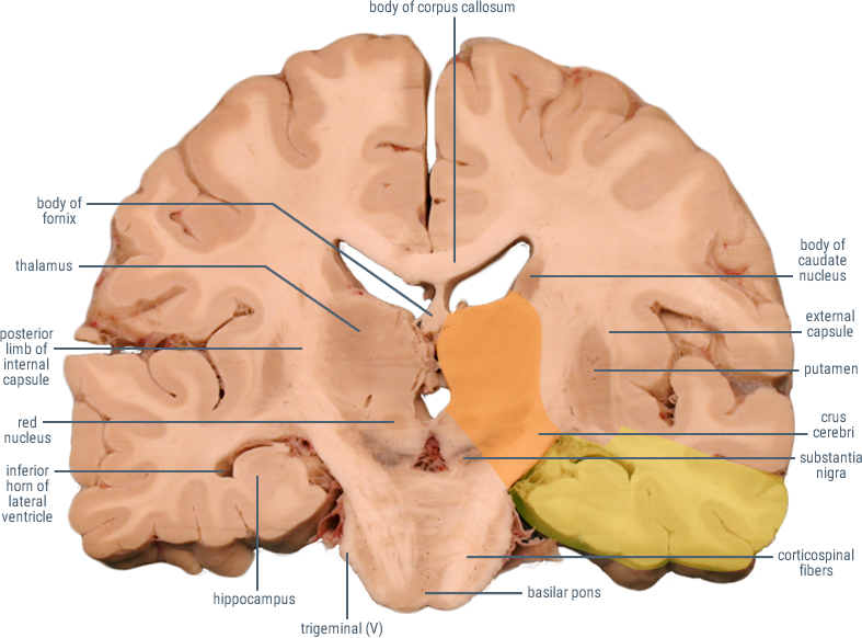 posterior cerebral artery distribution