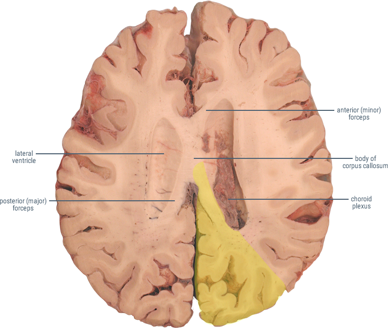 posterior cerebral artery distribution