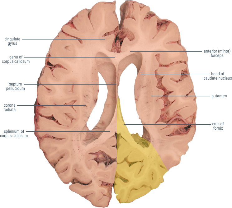 posterior cerebral artery distribution