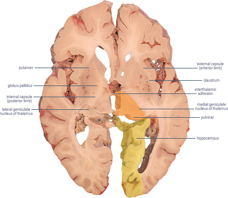 posterior cerebral artery distribution