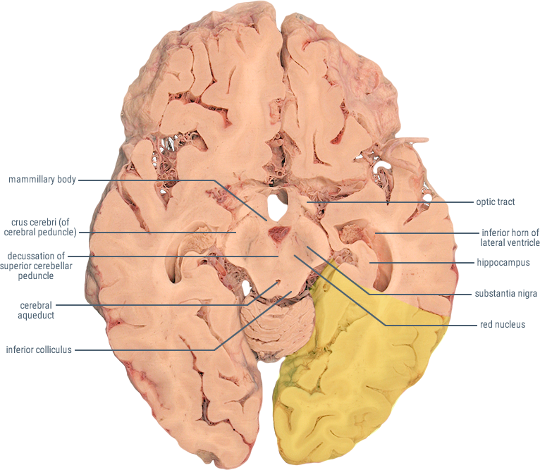 posterior cerebral artery distribution