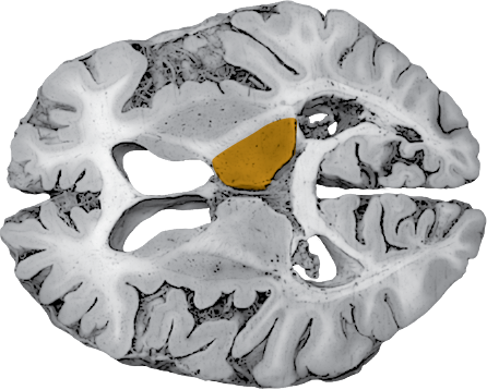 posterior cerebral artery territory