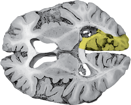 posterior cerebral artery distribution