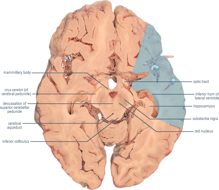 Левая средняя мозговая артерия инсульт. Поражение задней мозговой артерии. Бассейн средней мозговой артерии. Инсульт задней мозговой артерии. Инсульт в бассейне средней мозговой артерии.